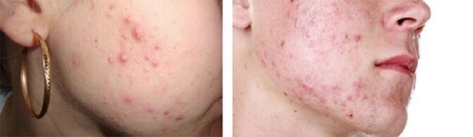 Eruzione cutanea come sintomo della presenza di vermi sottocutanei